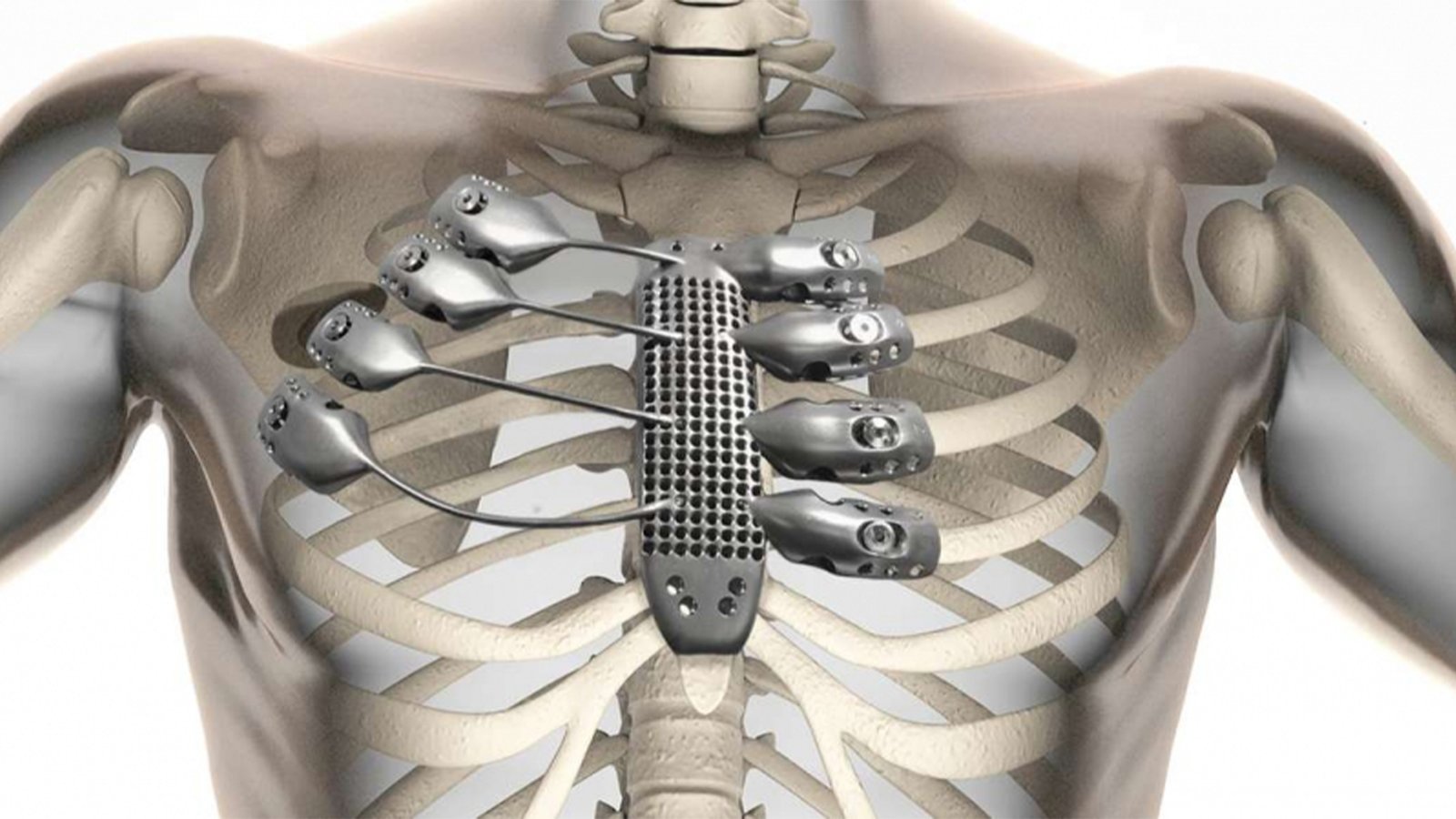 3D-printed-rib-cage-and-sternum-at-csiro-lab-22-in-australia